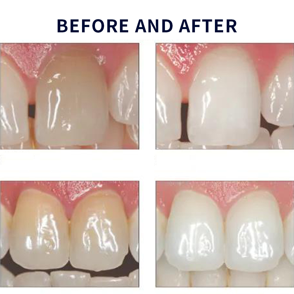 家庭用UV患者セット,プロの衛生機器,紫外線,16%,歯科材 - Teeth Whitening Near Me のレビューと価格