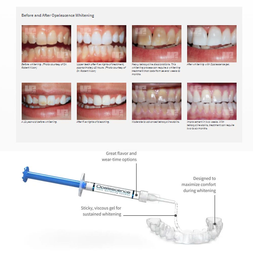家庭用UV患者セット,プロの衛生機器,紫外線,16%,歯科材 - Teeth Whitening Near Me のレビューと価格